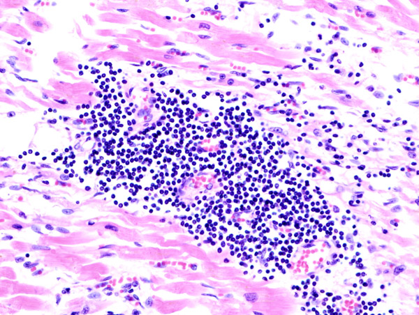 Histopathological image of viral inflammation of the heart at autopsy in a patient. Several young individuals have reported developing heart inflammation after receiving COVID-19 vaccines. (Image: BellRap via Wikimedia Commons CC BY-SA 3.0)