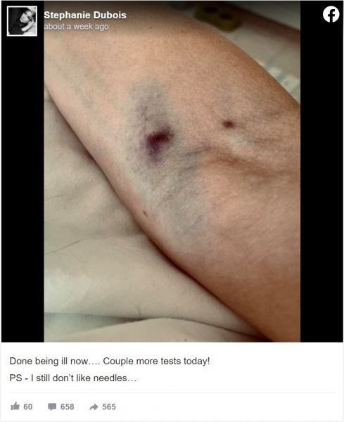 Severe bruising at the site of the AstraZeneca injection UK model Stephanie Dubois took in her final post before passing away. 