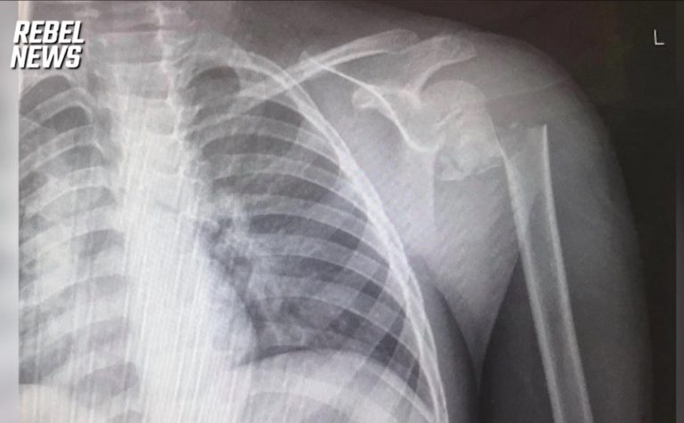 X-Ray of Zander, a 7-year-old Canadian boy's, broken humerus. His family says hospitals would not provide more than a sling after refusing a PCR test for COVID and insisting his medical mask exemption be respected
